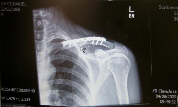 Clavicle injuries are common among cyclists